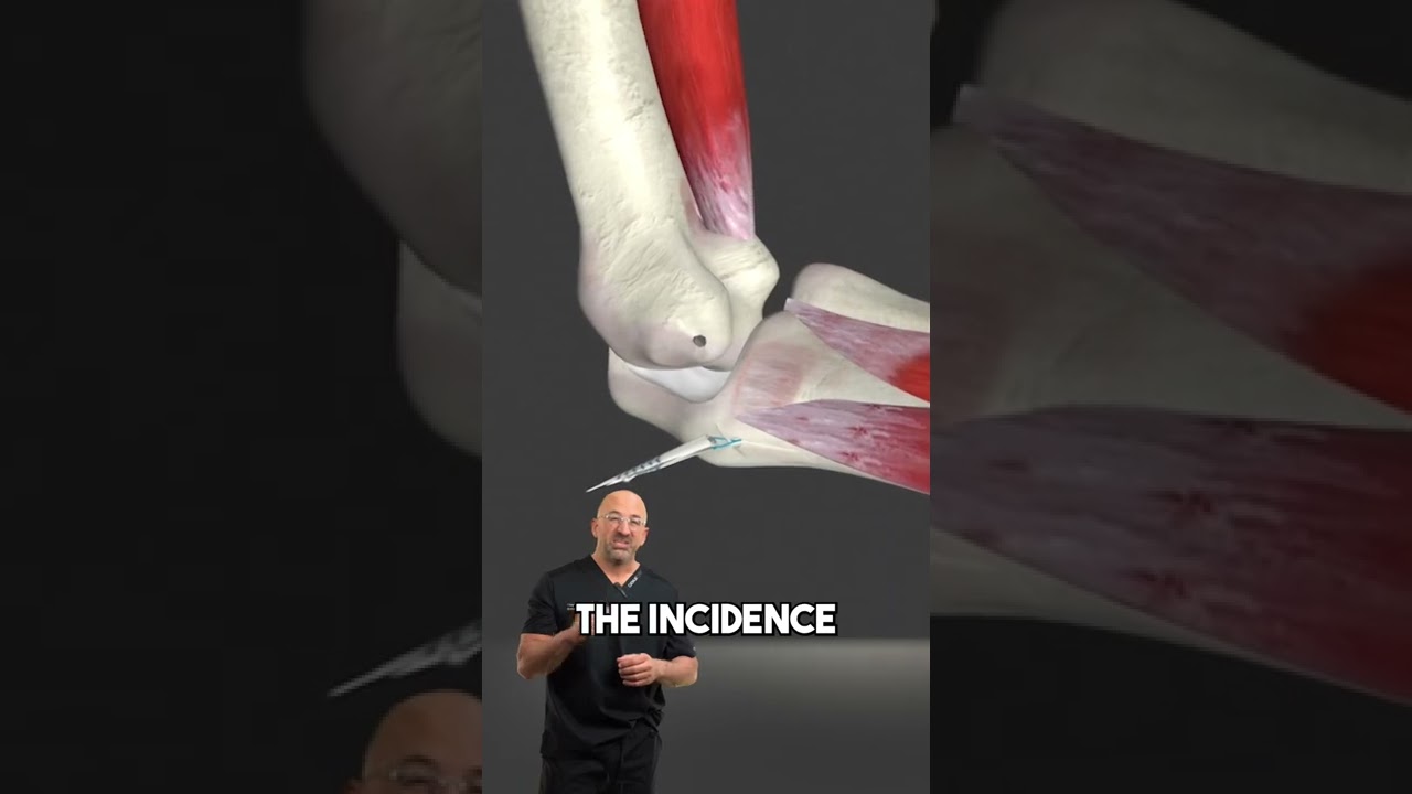 Tommy John Elbow Surgery & Faster Pitching #elbowsurgery #tommyjohn #baseballinjury