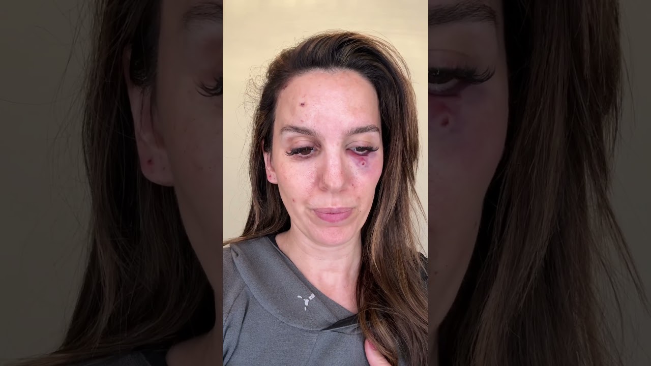 I was shot in the face by another party at a range. There’s a journey ahead but I will be okay.