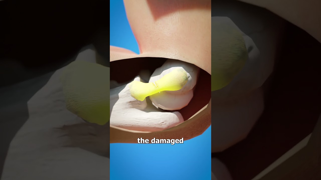 Tommy John Surgery 🤔 (explained)